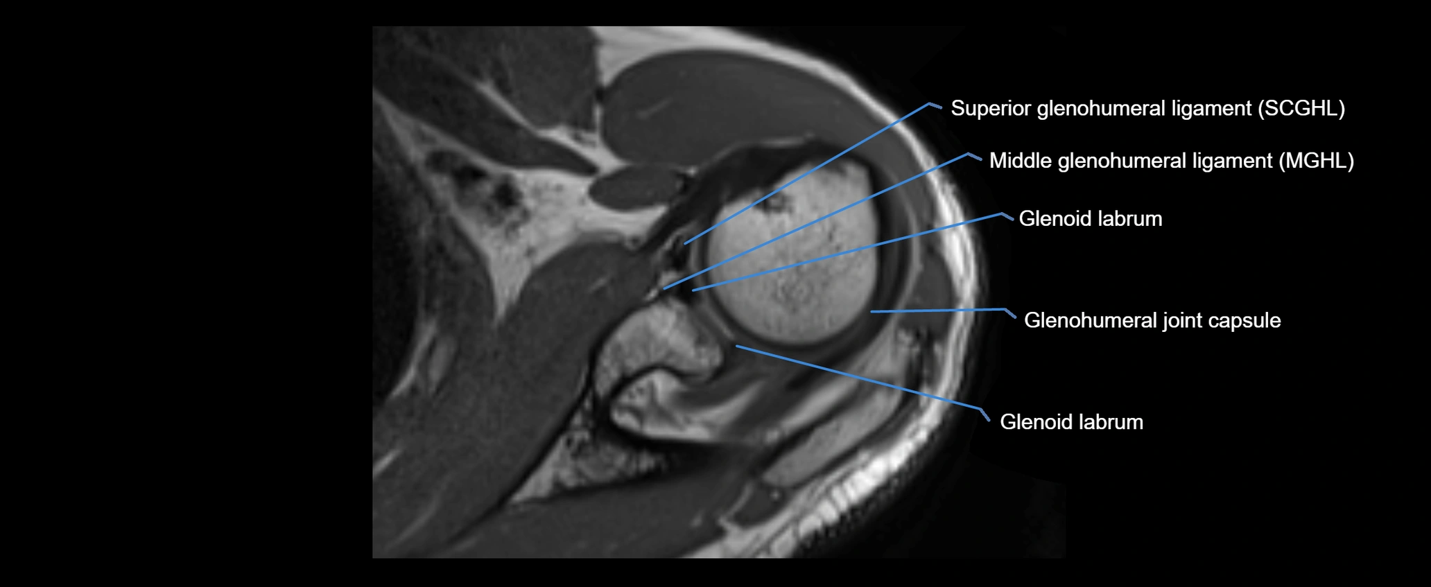 shoulder ligaments axial 3d 3t mri image-img-00005-00051.webp